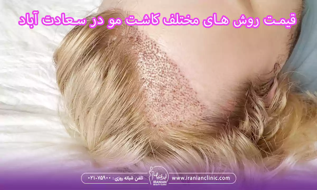 عوامل مؤثر بر قیمت کاشت مو در سعادت آباد تهران