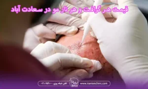 قیمت هر گرافت و هر تار مو در سعادت آباد