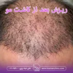 ریزش بعد از کاشت مو