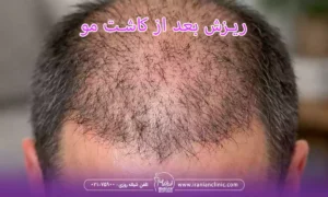 ریزش بعد از کاشت مو