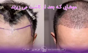 چه موهایی بعد از کاشت می ریزند؟