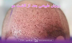آیا ریزش بعد از کاشت مو طبیعی است؟