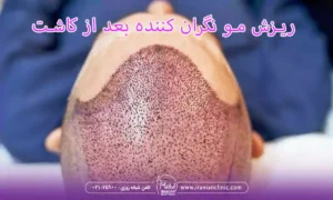 چه زمانی ریزش بعد از کاشت مو نگران کننده است؟