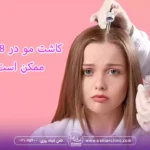کاشت مو در 18 سالگی