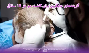 گزینه‌های جایگزین برای کاشت مو در 18 سالگی