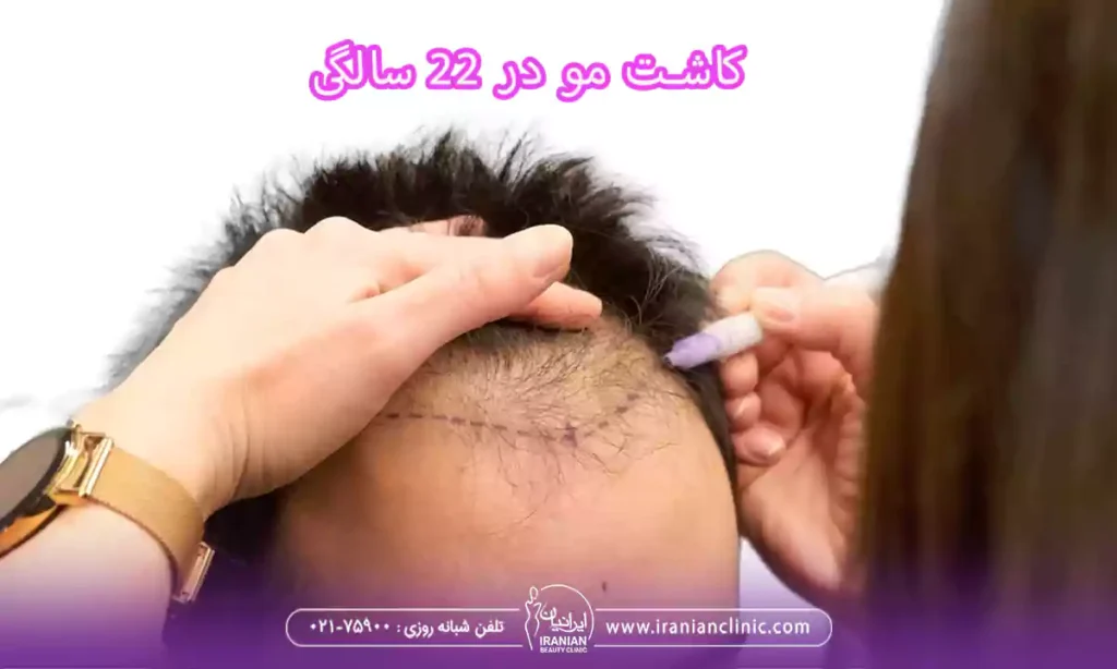کاشت مو در ۲۲ سالگی