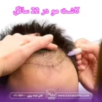 کاشت مو در ۲۲ سالگی