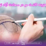 هزینه کاشت مو در سعادت آباد تهران و قیمت کاشت مو سعادت آباد تهران