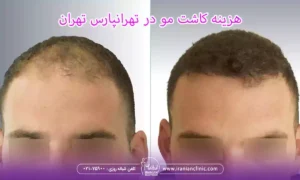 هزینه کاشت مو در تهرانپارس تهران و قیمت کاشت مو تهرانپارس تهران