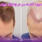 هزینه کاشت مو در زعفرانیه تهران و قیمت کاشت مو زعفرانیه تهران