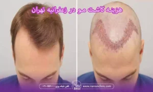 هزینه کاشت مو در زعفرانیه تهران و قیمت کاشت مو زعفرانیه تهران