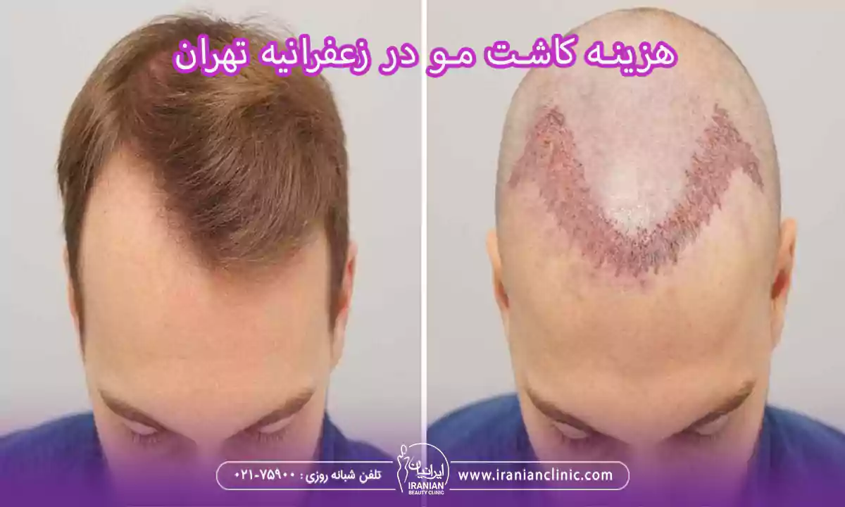 هزینه کاشت مو در زعفرانیه تهران و قیمت کاشت مو زعفرانیه تهران