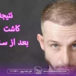 نتیجه کاشت مو بعد از سه ماه