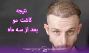 نتیجه کاشت مو بعد از سه ماه