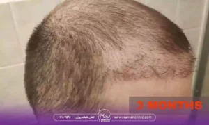 آیا نتیجه کاشت مو بعد از سه ماه برای همه افراد یکسان است؟