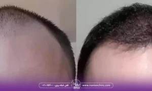 راه های ماندگاری نتیجه کاشت مو بعد از سه ماه