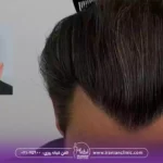 کاشت مو با تراکم بالا و بهترین روش کاشت مو با تراکم بالا