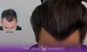 کاشت مو با تراکم بالا و بهترین روش کاشت مو با تراکم بالا