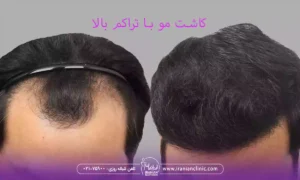 عکس کاشت مو با تراکم بالا