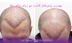 بهترین روش های کاشت مو برای تراکم بالا