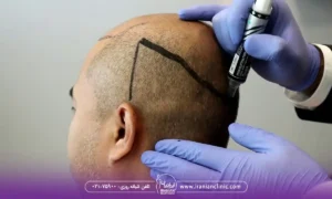 عوامل مؤثر بر هزینه کاشت مو به روش تکثیر