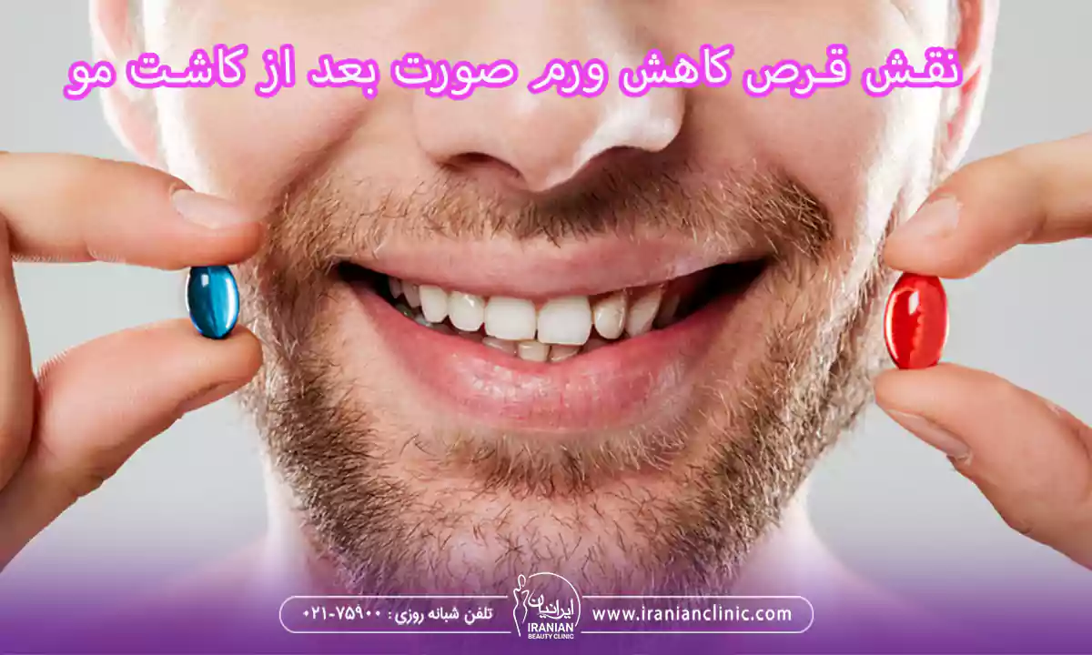 نقش قرص کاهش ورم صورت در بهبود بعد از کاشت مو