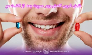 نقش قرص کاهش ورم صورت در بهبود بعد از کاشت مو