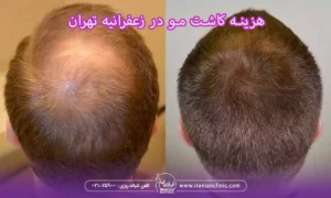 عوامل مؤثر بر قیمت کاشت مو در زعفرانیه تهران