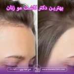 بهترین دکتر کاشت مو زنان و متخصص کاشت مو خانم ها