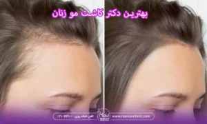 بهترین دکتر کاشت مو زنان و متخصص کاشت مو خانم ها