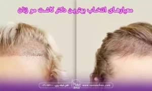 معیارهای انتخاب بهترین دکتر کاشت مو زنان