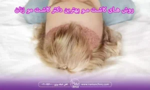 روش های کاشت مو بهترین دکتر کاشت مو زنان در تهران