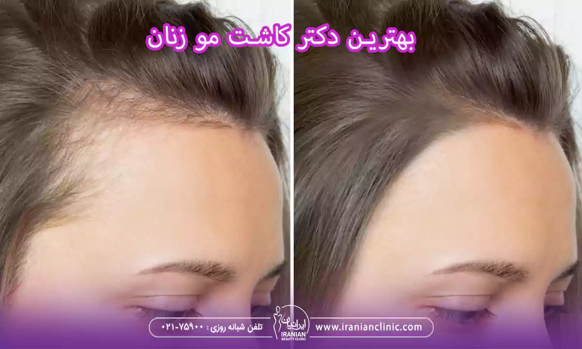 بهترین دکتر کاشت مو زنان و متخصص کاشت مو خانم ها