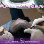 بهترین روش کاشت مو با تراکم بالا