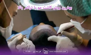 بهترین روش کاشت مو با تراکم بالا