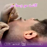 کاشت مو وسط سر و کاشت مو ورتکس