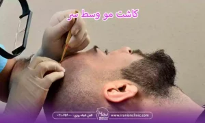 کاشت مو وسط سر و کاشت مو ورتکس