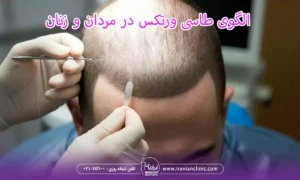 الگوی طاسی ورتکس در مردان و زنان