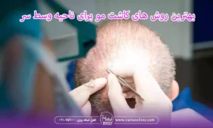 بهترین روش های کاشت مو برای ناحیه وسط سر