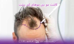 کاشت مو بین موهای کم پشت