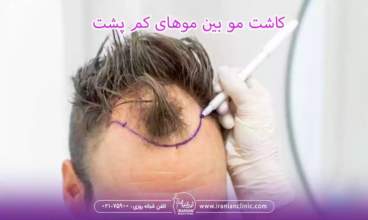 کاشت مو بین موهای کم پشت
