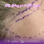 هزینه کاشت مو پیشانی زنان و قیمت کاشت مو پیشانی زنان