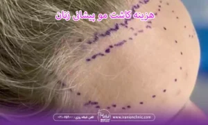 هزینه کاشت مو پیشانی زنان و قیمت کاشت مو پیشانی زنان