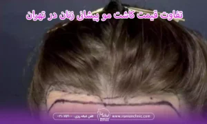 تفاوت قیمت کاشت مو پیشانی زنان در تهران و سایر مناطق