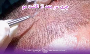 چربی سر بعد از کاشت مو