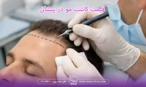 قیمت کاشت مو در پیشانی و هزینه کاشت مو در پیشانی