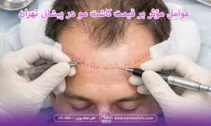 عوامل مؤثر بر قیمت کاشت مو در پیشانی تهران