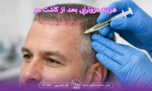هزینه مزوتراپی بعد از کاشت مو و قیمت مزوتراپی بعد از کاشت مو