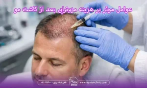 عوامل موثر بر هزینه مزوتراپی بعد از کاشت مو