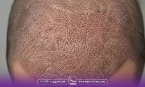 خشکی پوست سر بعد از کاشت مو علائمی که باید بدانید و درمان آن